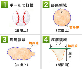 スーパー神経最適化療法（スーパーSSR）